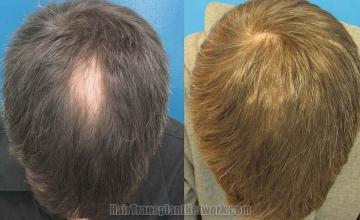 Top view before and after hair restoration results