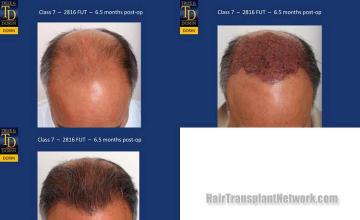 Top view - Before and after surgical hair replacement