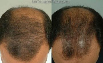 Hair transplant surgery before and after pictures