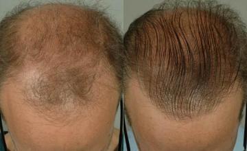 Hair transplantation surgery before and after photos