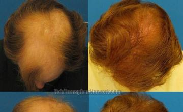 Hair transplantation surgery before and after images