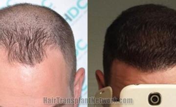 Hair restoration procedure before and after results