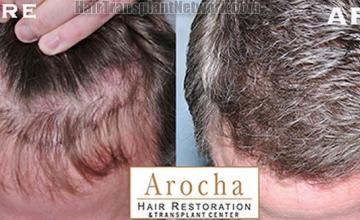 Top view before and after hair restoration results