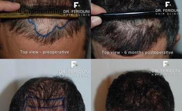 Hair restoration procedure before and after results