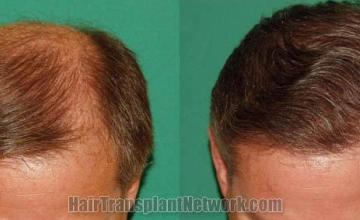 Hair restoration procedure before and after results