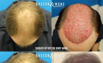 Before and after hair restoration procedure images