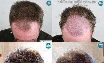 Hair transplantation surgery before and after photos