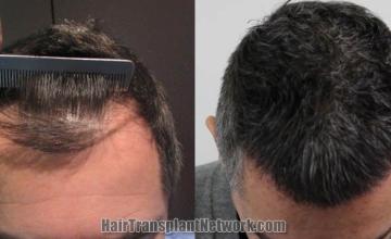 Hair restoration procedure before and after results