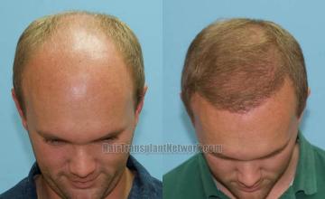 Hair transplantation surgery before and after images