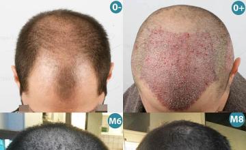 Hair transplantation surgery before and after images