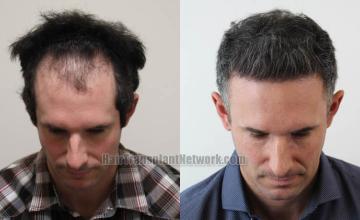 Hair transplantation surgery before and after images