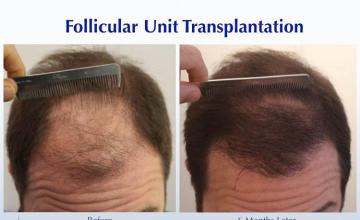 Hair restoration procedure before and after results