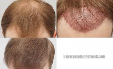 Hair restoration procedure before and after results