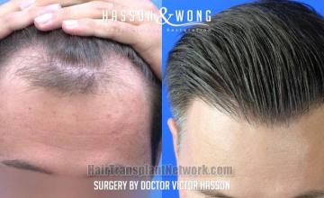 Before and after hair restoration procedure images