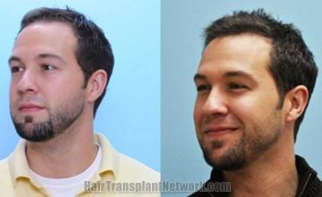 Hair transplantation surgery before and after pictures