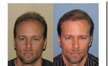 Hair restoration procedure results