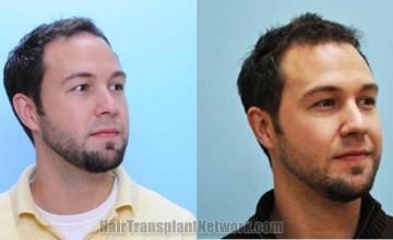 Hair transplantation surgery before and after images