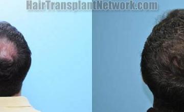 Hair restoration procedure before and after pictures