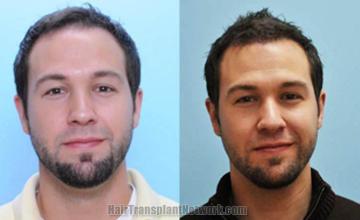 Hair restoration procedure before and after results
