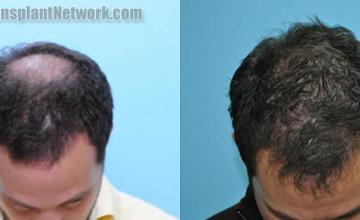 Hair transplantation surgery before and after photos