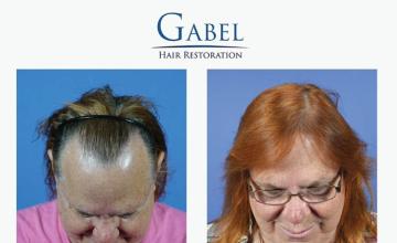 Hair replacement procedure before and after images