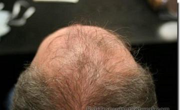 Hair restoration procedure results