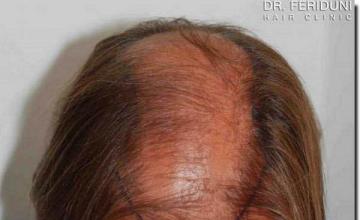 Hair restoration procedure results