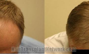 Top view - before and after hair restoration images