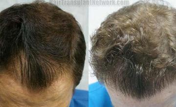 Before and three years postoperative hair transplant photos