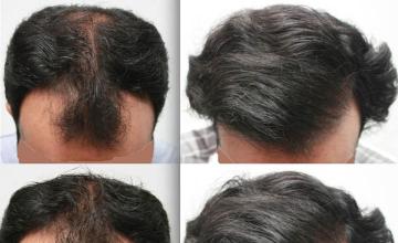 Hair transplantation surgery before and after photos