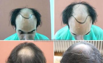 Hair transplantation surgery before and after images