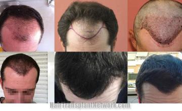 Hair restoration procedure before and after results