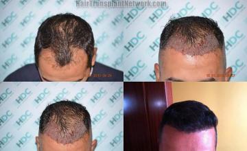 Hair transplantation surgery before and after photos