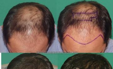 Top view before and after hair restoration results