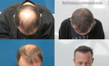 Hair restoration procedure before and after results