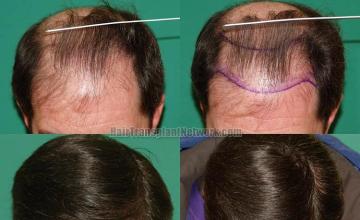 Before and after hair transplant procedure images