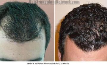 Hair transplantation surgery before and after photos