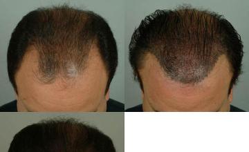 Hair transplantation surgery before and after photos