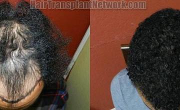 Hair restoration procedure before and after results