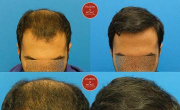 Hair transplantation surgery before and after photos