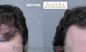 Hair transplantation surgery before and after photos