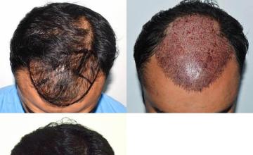 Hair restoration procedure before and after results