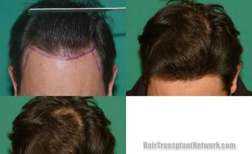 Top view before and after hair restoration results