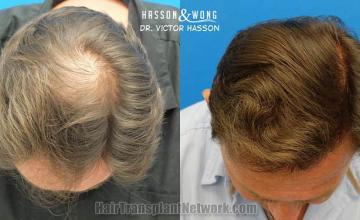 Hair transplantation surgery before and after photos