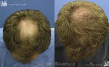 Hair restoration procedure before and after results