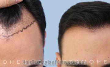 Top view - Before and after hair restoration results