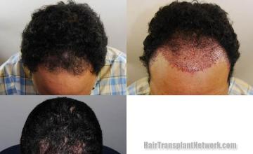Before and after hair transplant procedure images