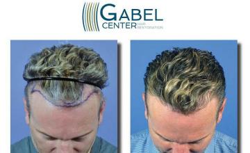 Hair restoration procedure before and after result photos