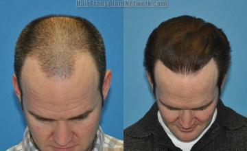 Hair restoration procedure before and after result photos