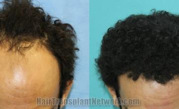 Top view - Before and after hair restoration results